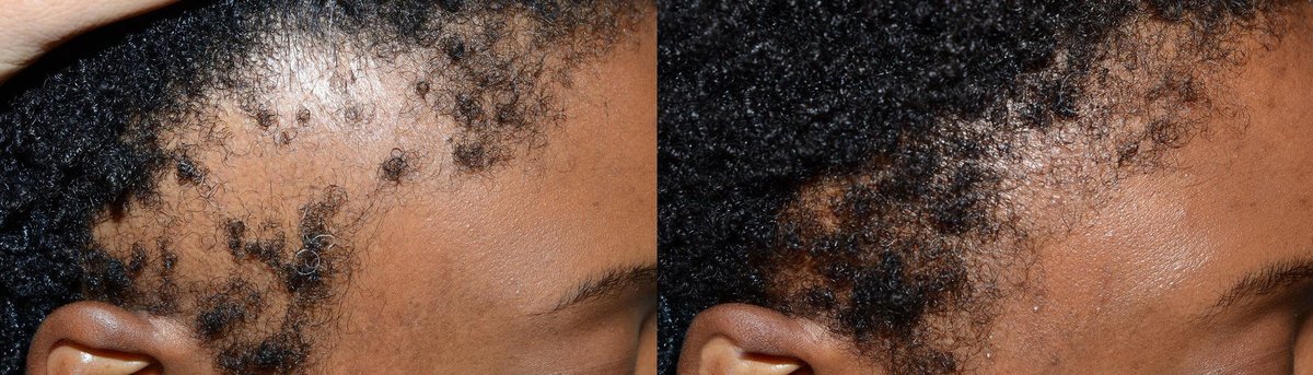 Artistic Hair Transplant Centre - Artistic Hair Transplant Centre