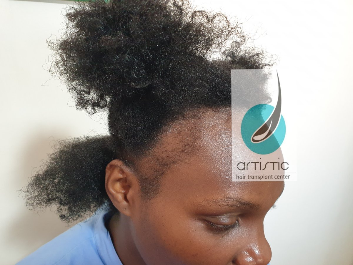 Artistic Hair Transplant Centre - Artistic Hair Transplant Centre