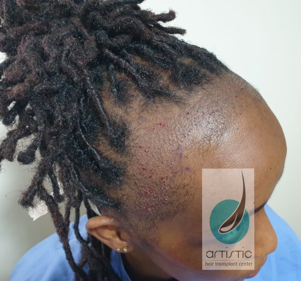 Artistic Hair Transplant Centre - Artistic Hair Transplant Centre