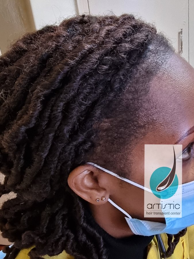 Artistic Hair Transplant Centre - Artistic Hair Transplant Centre