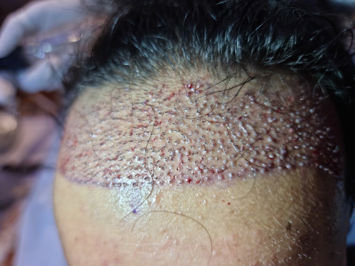 Artistic Hair Transplant Centre - Artistic Hair Transplant Centre