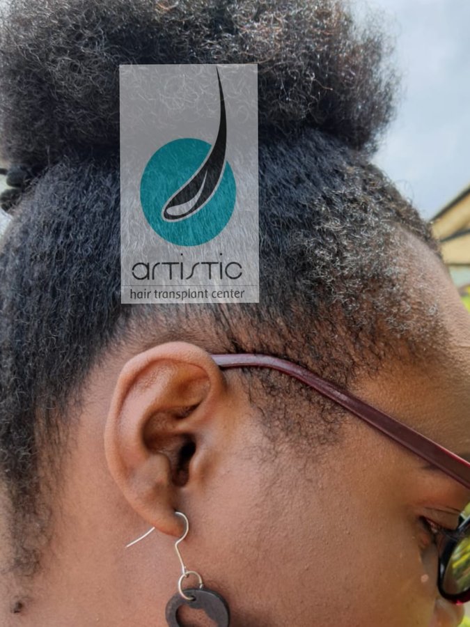 Artistic Hair Transplant Centre - Artistic Hair Transplant Centre