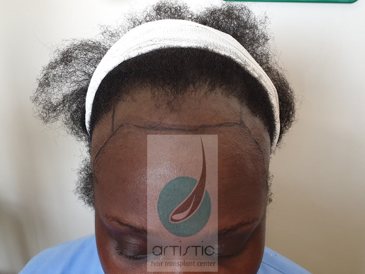 Artistic Hair Transplant Centre - Artistic Hair Transplant Centre