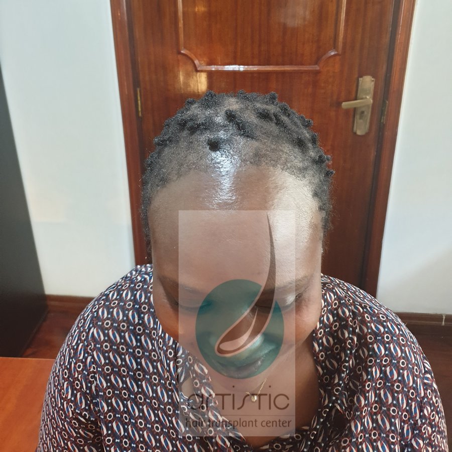 Artistic Hair Transplant Centre - Artistic Hair Transplant Centre