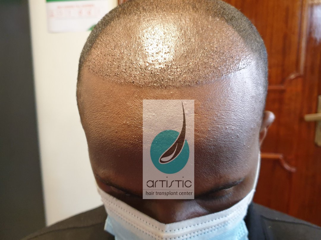 Artistic Hair Transplant Centre - Artistic Hair Transplant Centre
