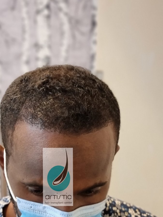 Artistic Hair Transplant Centre - Artistic Hair Transplant Centre