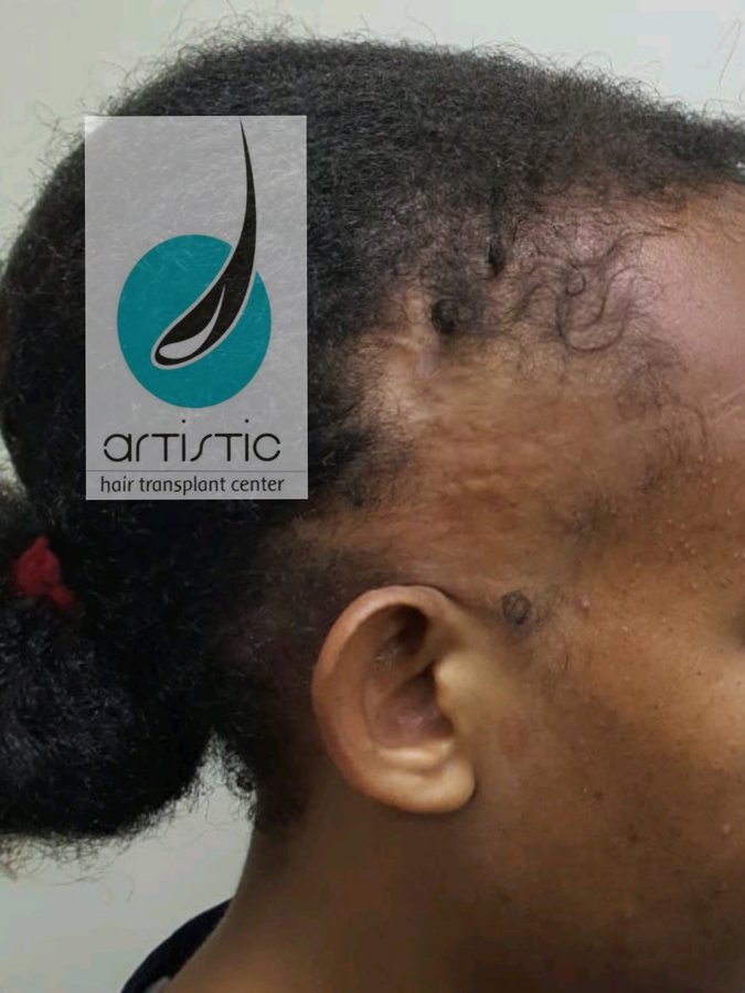 Artistic Hair Transplant Centre - Artistic Hair Transplant Centre