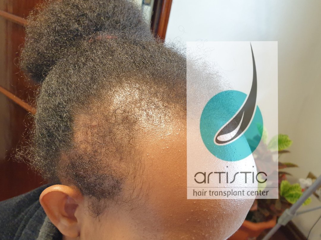 Artistic Hair Transplant Centre - Artistic Hair Transplant Centre