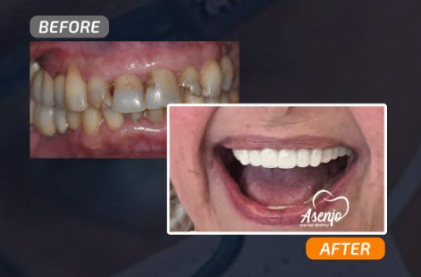 Asenjo One Visit Dentistry - Asenjo One Visit Dentistry