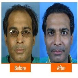 Asg Hair Transplant -Jalandhar - Asg Hair Transplant -Jalandhar