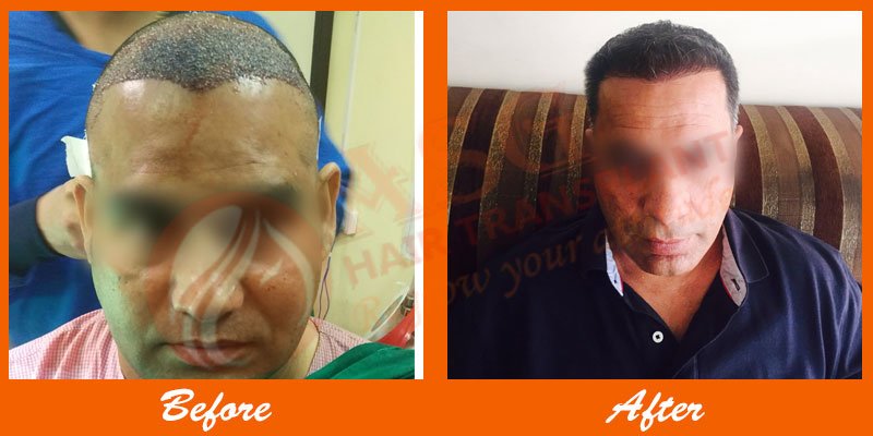 Asg Hair Transplant -Jalandhar - Asg Hair Transplant -Jalandhar