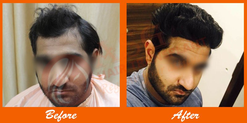 Asg Hair Transplant -Jalandhar - Asg Hair Transplant -Jalandhar