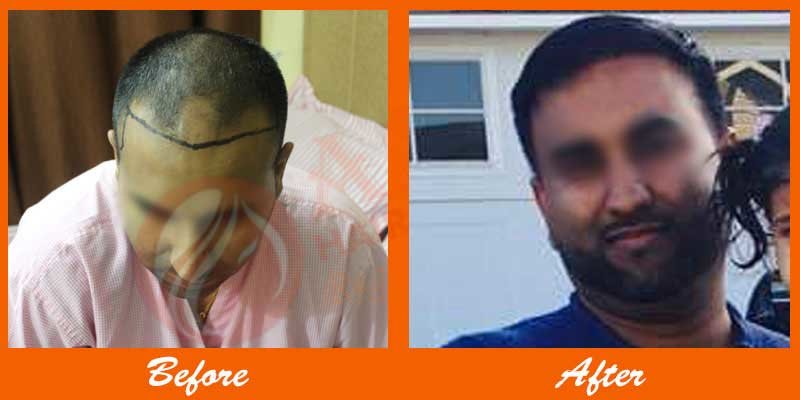 Asg Hair Transplant -Jalandhar - Asg Hair Transplant -Jalandhar