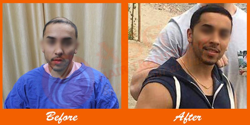 Asg Hair Transplant -Jalandhar - Asg Hair Transplant -Jalandhar