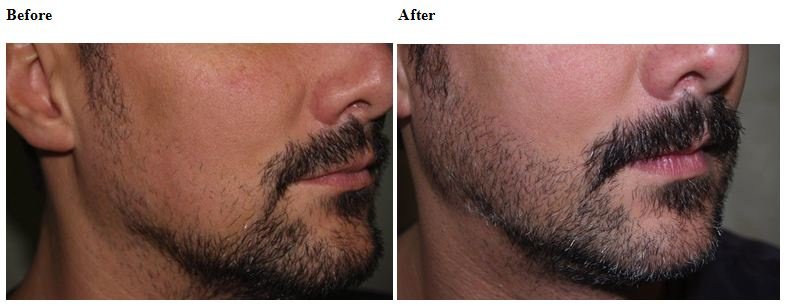 Asg Hair Transplant -Jalandhar - Asg Hair Transplant -Jalandhar
