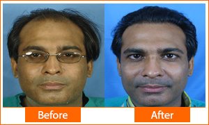 Asg Hair Transplant -Jalandhar - Asg Hair Transplant -Jalandhar
