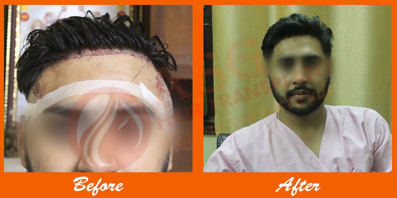 Asg Hair Transplant -Jalandhar - Asg Hair Transplant -Jalandhar