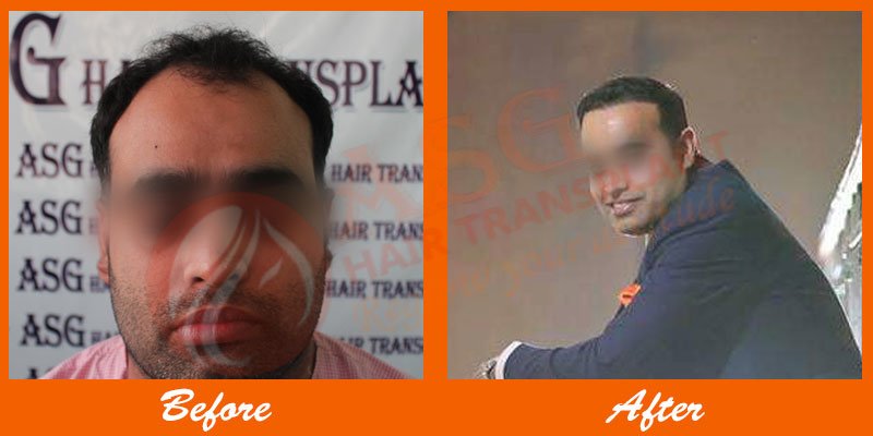 Asg Hair Transplant -Jalandhar - Asg Hair Transplant -Jalandhar