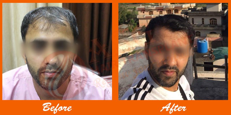 Asg Hair Transplant -Jalandhar - Asg Hair Transplant -Jalandhar