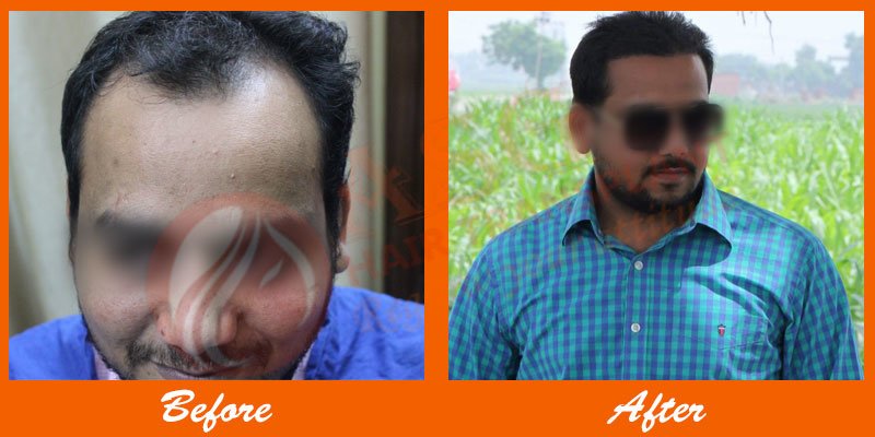Asg Hair Transplant -Jalandhar - Asg Hair Transplant -Jalandhar