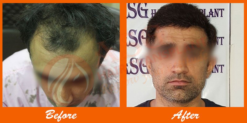 Asg Hair Transplant - Ludhiana - Asg Hair Transplant - Ludhiana