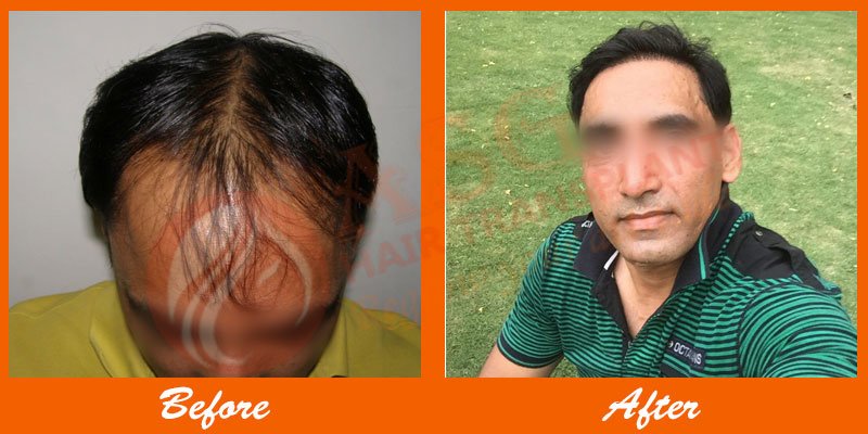 Asg Hair Transplant - Ludhiana - Asg Hair Transplant - Ludhiana
