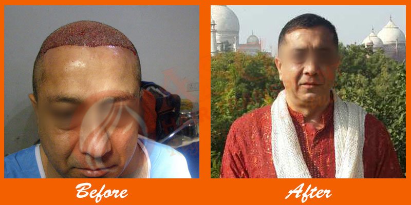 Asg Hair Transplant - Ludhiana - Asg Hair Transplant - Ludhiana