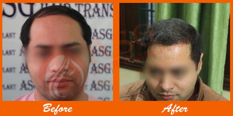 Asg Hair Transplant - Ludhiana - Asg Hair Transplant - Ludhiana
