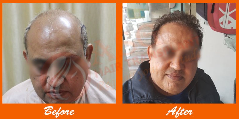 Asg Hair Transplant - Ludhiana - Asg Hair Transplant - Ludhiana