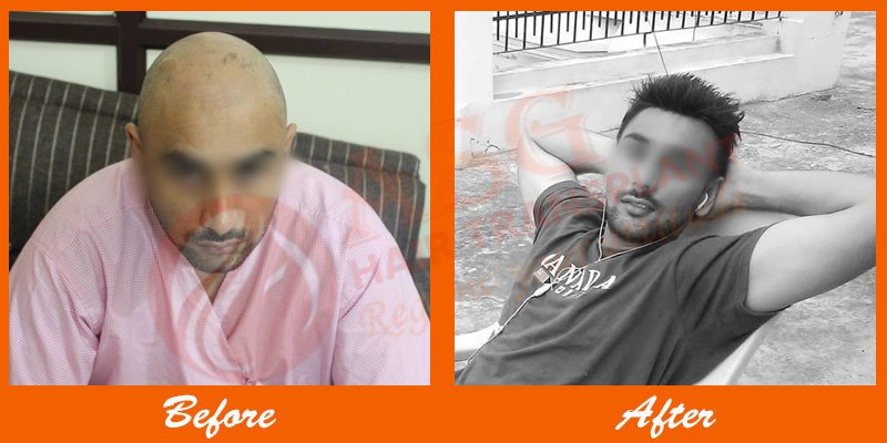 Asg Hair Transplant - Ludhiana - Asg Hair Transplant - Ludhiana
