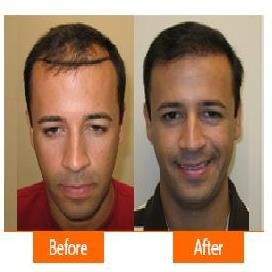 Asg Hair Transplant - Ludhiana - Asg Hair Transplant - Ludhiana