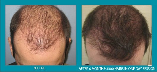 Asg Hair Transplant - Ludhiana - Asg Hair Transplant - Ludhiana