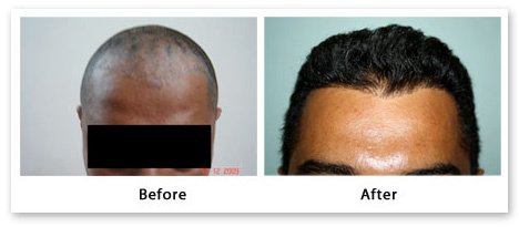 Asg Hair Transplant - Ludhiana - Asg Hair Transplant - Ludhiana