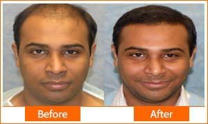 Asg Hair Transplant - Ludhiana - Asg Hair Transplant - Ludhiana