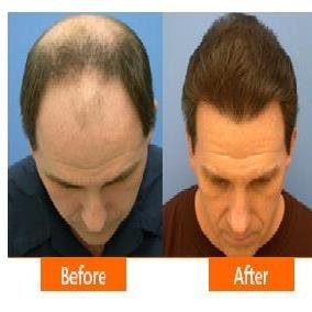 Asg Hair Transplant - Ludhiana - Asg Hair Transplant - Ludhiana