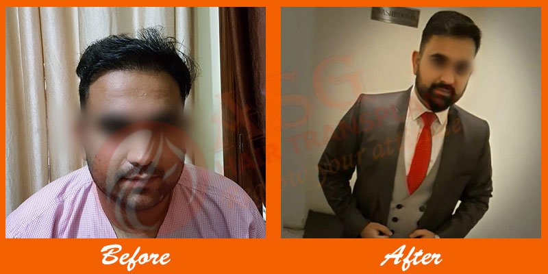 Asg Hair Transplant - Ludhiana - Asg Hair Transplant - Ludhiana