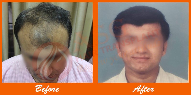 Asg Hair Transplant - Ludhiana - Asg Hair Transplant - Ludhiana