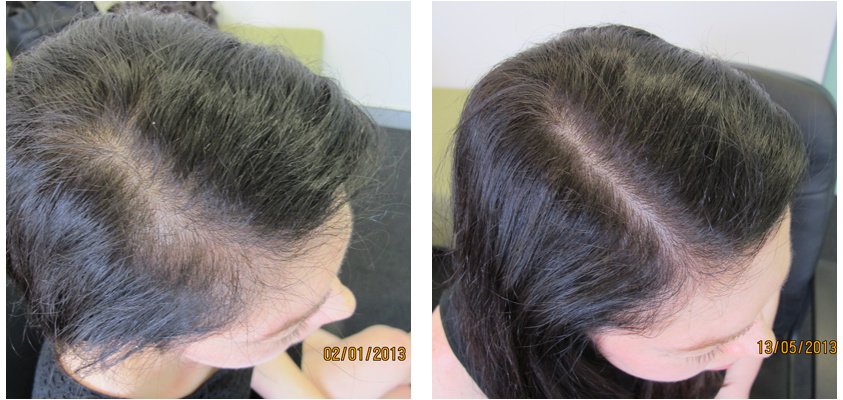 Ashley and Martin Hair Loss Centre - Singapore - Ashley and Martin Hair Loss Centre - Singapore