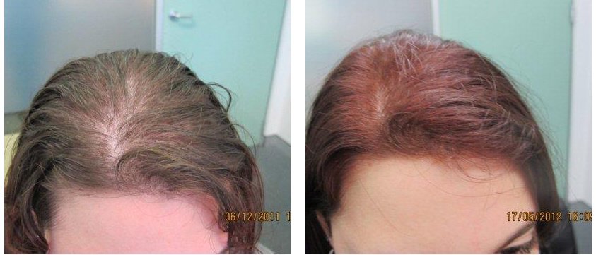 Ashley and Martin Hair Loss Centre - Singapore - Ashley and Martin Hair Loss Centre - Singapore