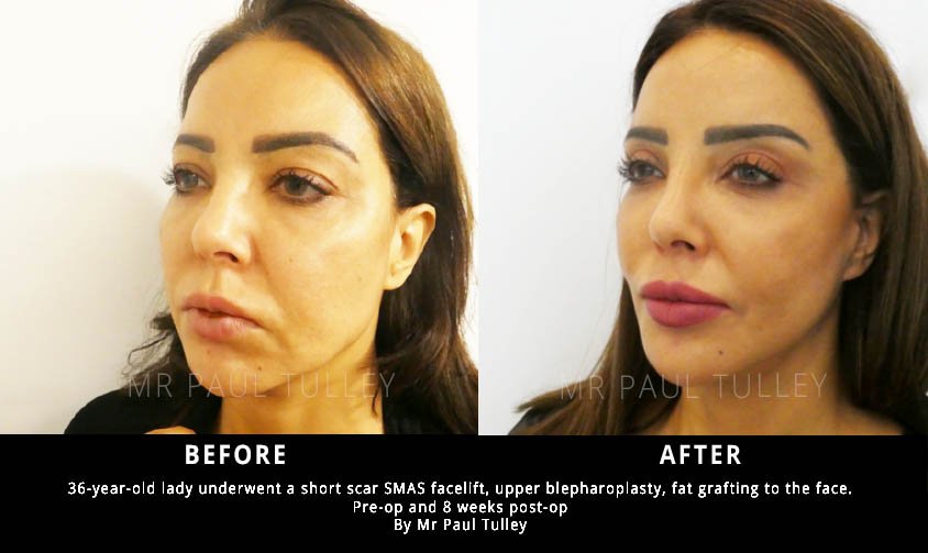 Ashtead Hospital - Ashtead Hospital