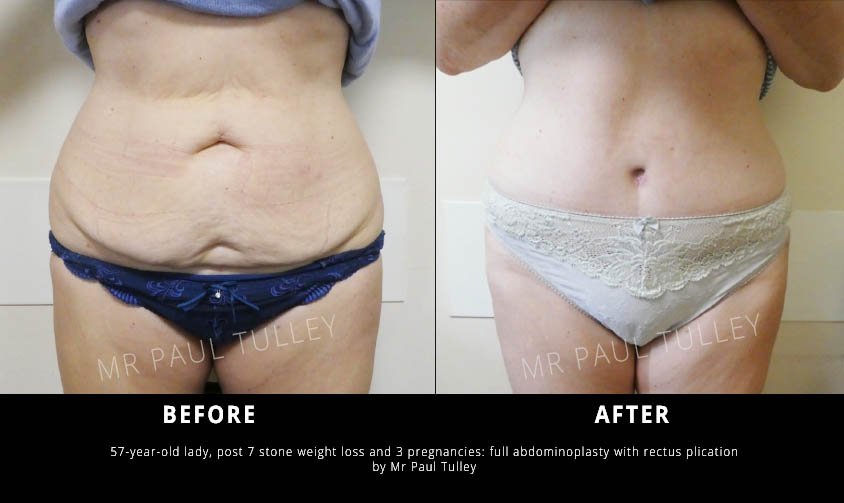 Ashtead Hospital - Ashtead Hospital