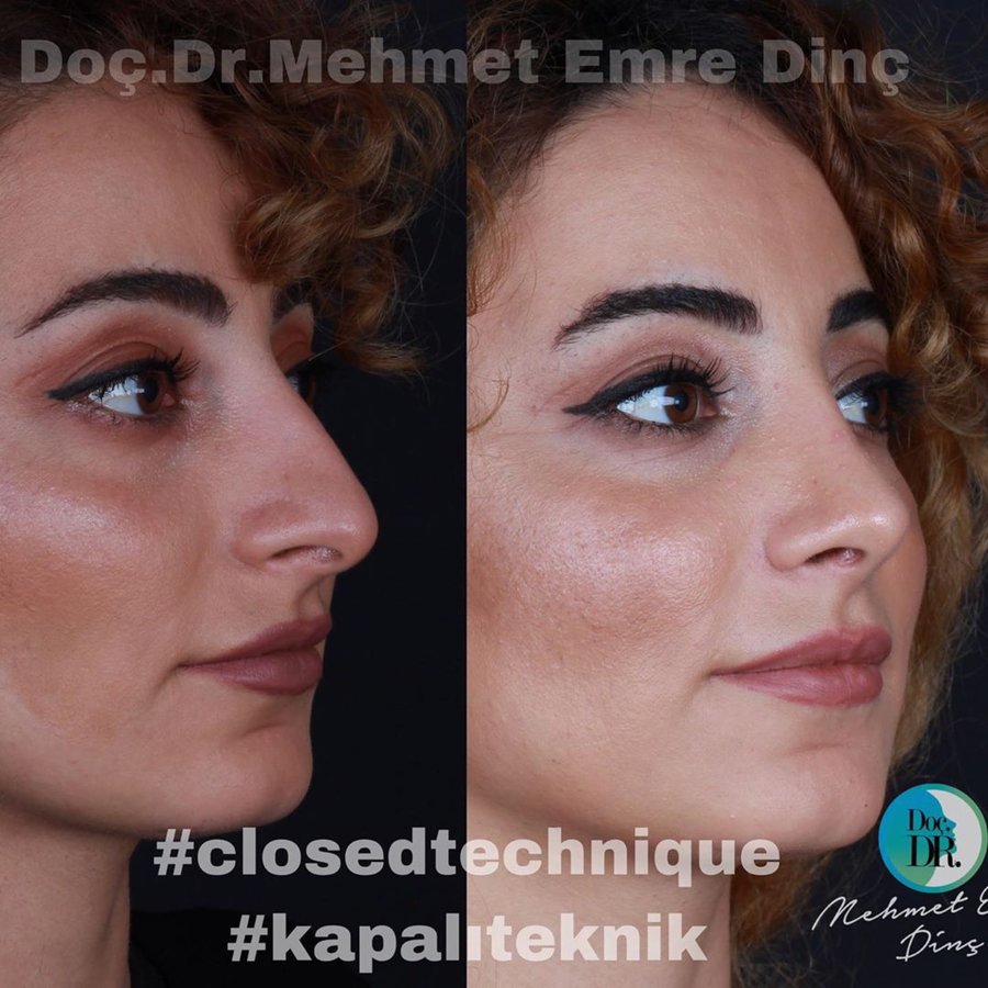 مساعد الأستاذ الدكتور محمد إمري دينك - مركز اسطنبول لجراحة الأنف - Assoc. Prof. Dr. Mehmet Emre Dinc - Istanbul Rhinoplasty Center