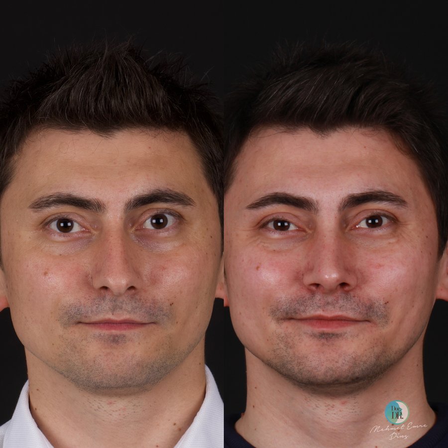 مساعد الأستاذ الدكتور محمد إمري دينك - مركز اسطنبول لجراحة الأنف - Assoc. Prof. Dr. Mehmet Emre Dinc - Istanbul Rhinoplasty Center