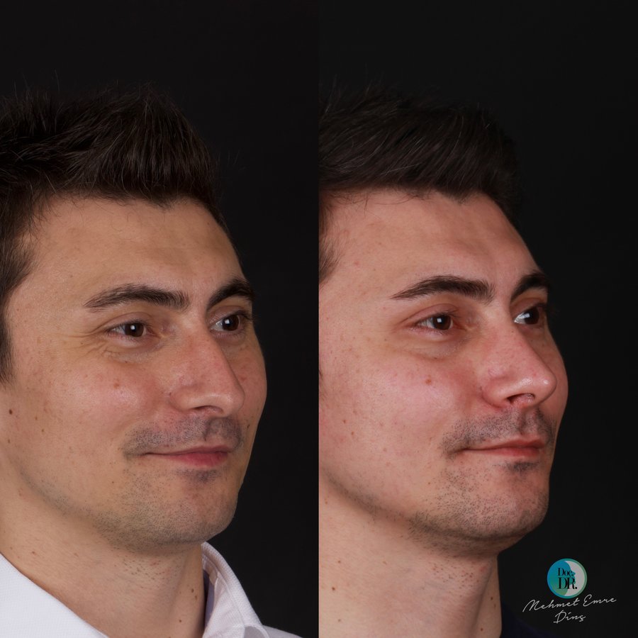 مساعد الأستاذ الدكتور محمد إمري دينك - مركز اسطنبول لجراحة الأنف - Assoc. Prof. Dr. Mehmet Emre Dinc - Istanbul Rhinoplasty Center