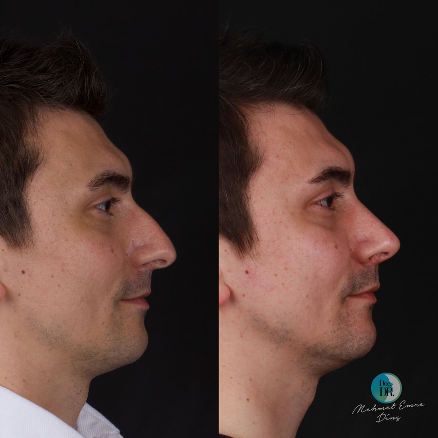 مساعد الأستاذ الدكتور محمد إمري دينك - مركز اسطنبول لجراحة الأنف - Assoc. Prof. Dr. Mehmet Emre Dinc - Istanbul Rhinoplasty Center