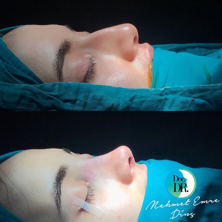 مساعد الأستاذ الدكتور محمد إمري دينك - مركز اسطنبول لجراحة الأنف - Assoc. Prof. Dr. Mehmet Emre Dinc - Istanbul Rhinoplasty Center