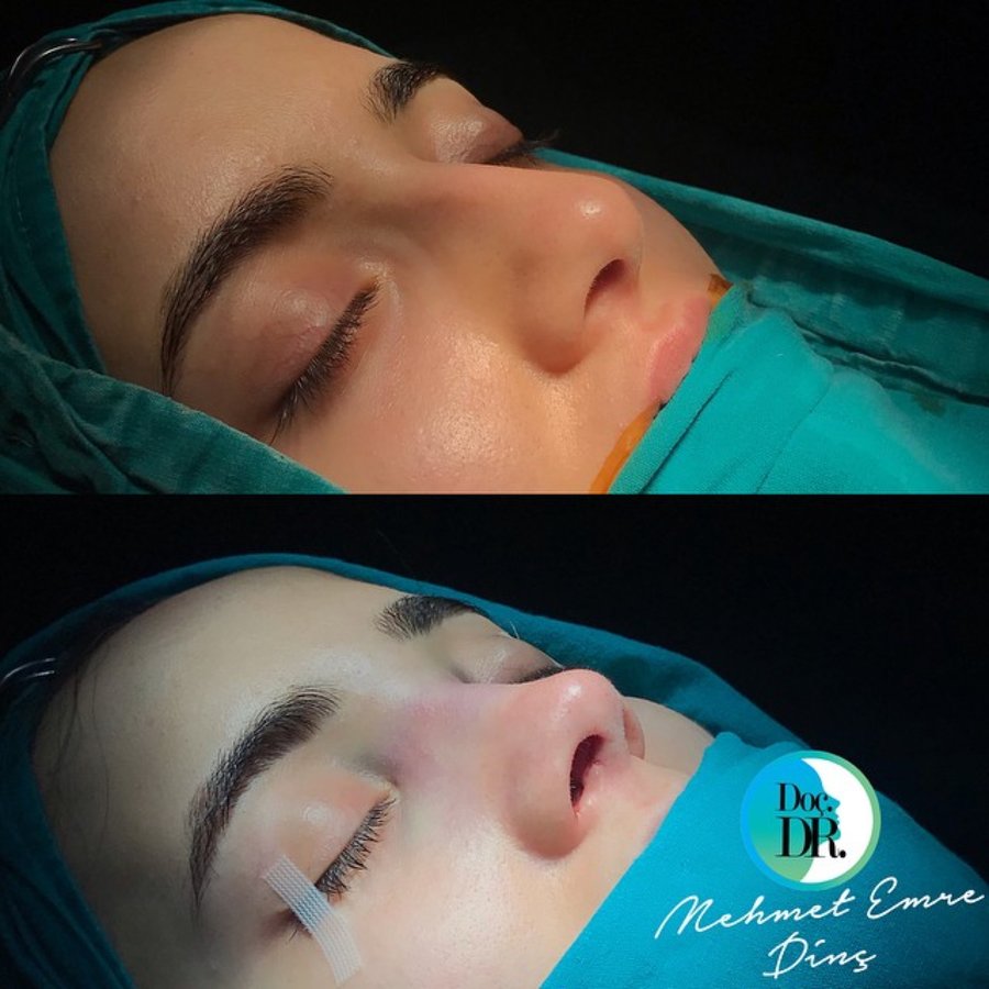 مساعد الأستاذ الدكتور محمد إمري دينك - مركز اسطنبول لجراحة الأنف - Assoc. Prof. Dr. Mehmet Emre Dinc - Istanbul Rhinoplasty Center