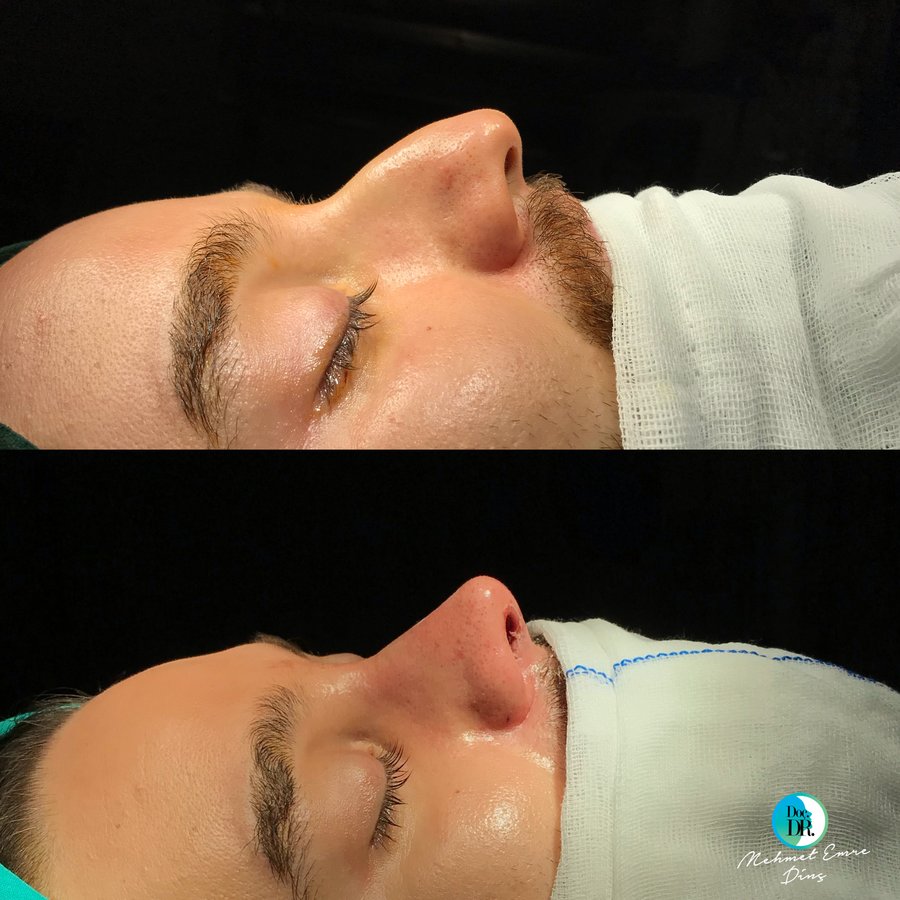 مساعد الأستاذ الدكتور محمد إمري دينك - مركز اسطنبول لجراحة الأنف - Assoc. Prof. Dr. Mehmet Emre Dinc - Istanbul Rhinoplasty Center