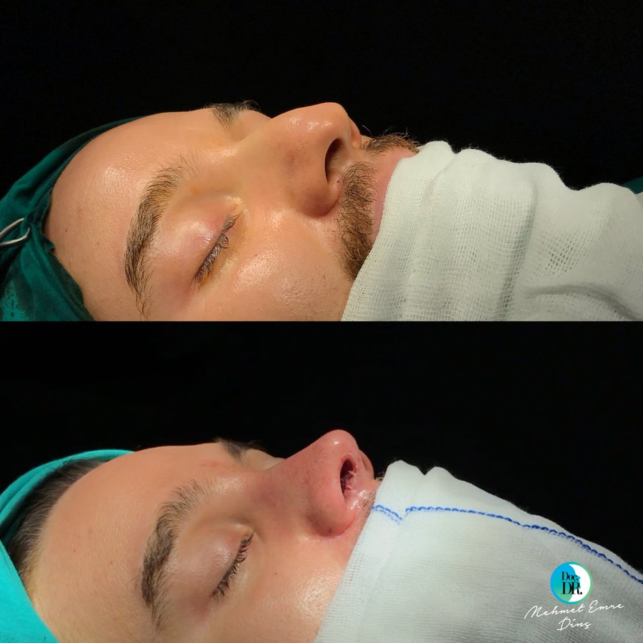 مساعد الأستاذ الدكتور محمد إمري دينك - مركز اسطنبول لجراحة الأنف - Assoc. Prof. Dr. Mehmet Emre Dinc - Istanbul Rhinoplasty Center