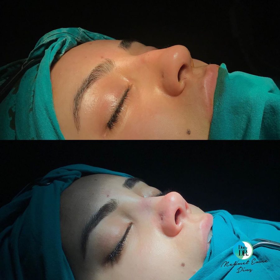 مساعد الأستاذ الدكتور محمد إمري دينك - مركز اسطنبول لجراحة الأنف - Assoc. Prof. Dr. Mehmet Emre Dinc - Istanbul Rhinoplasty Center